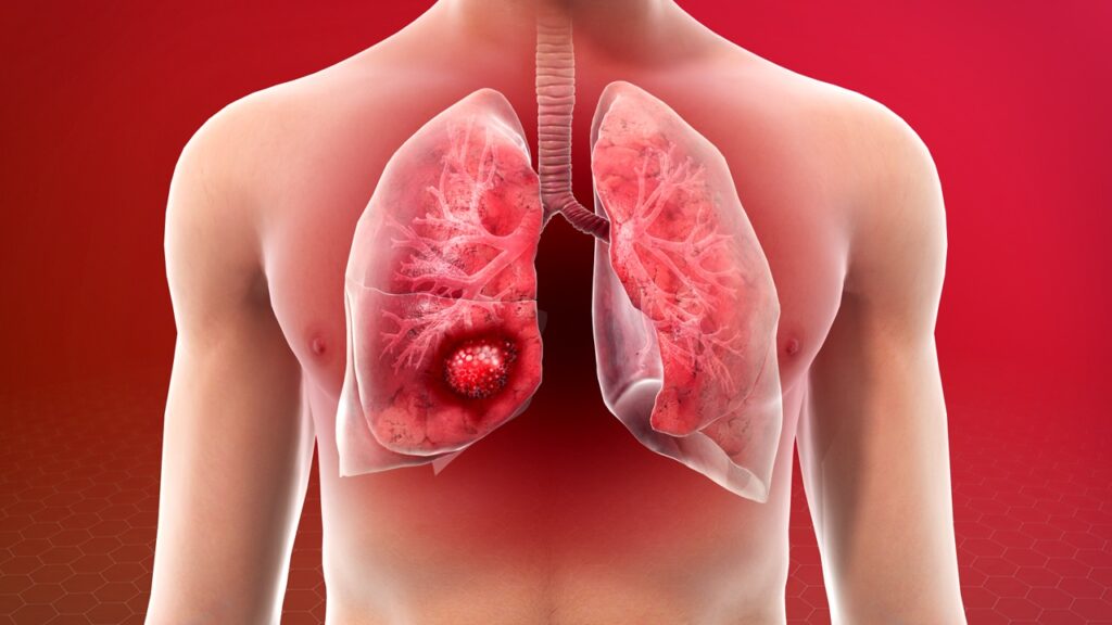 health-lung-cancer-in-non-smokers-rising-lung-cancer-cases-among-non-smokers-know-its-causes