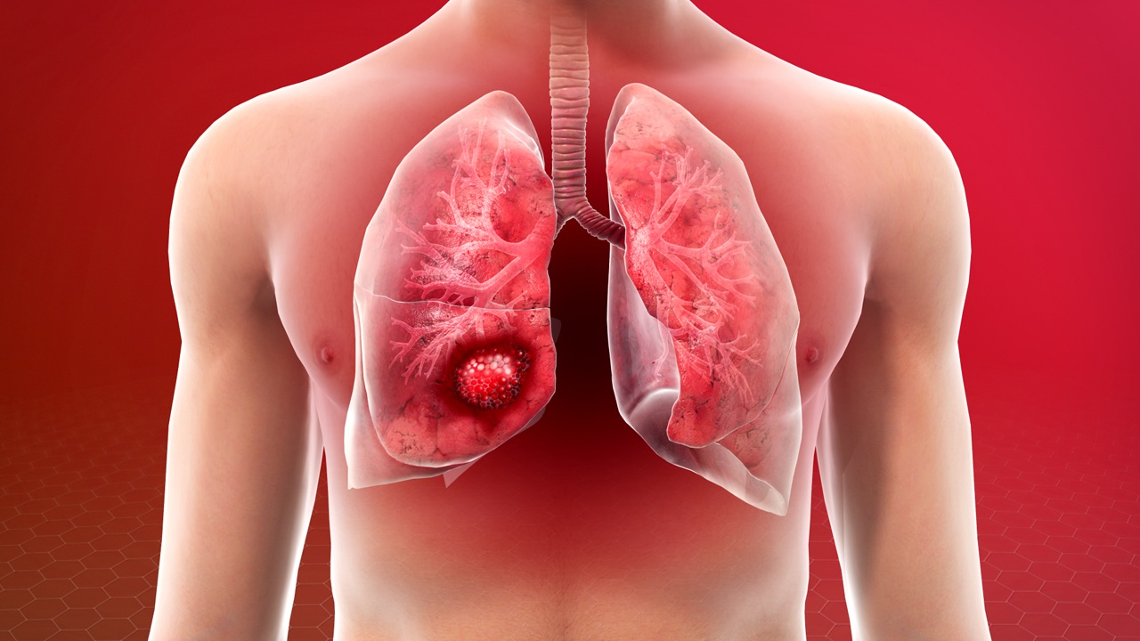 health-lung-cancer-in-non-smokers-rising-lung-cancer-cases-among-non-smokers-know-its-causes